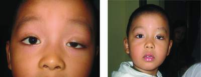 phuong phap chua sup mi bam sinh moi